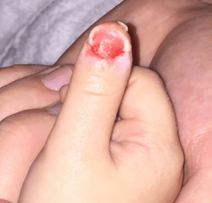 thumb nail torn off